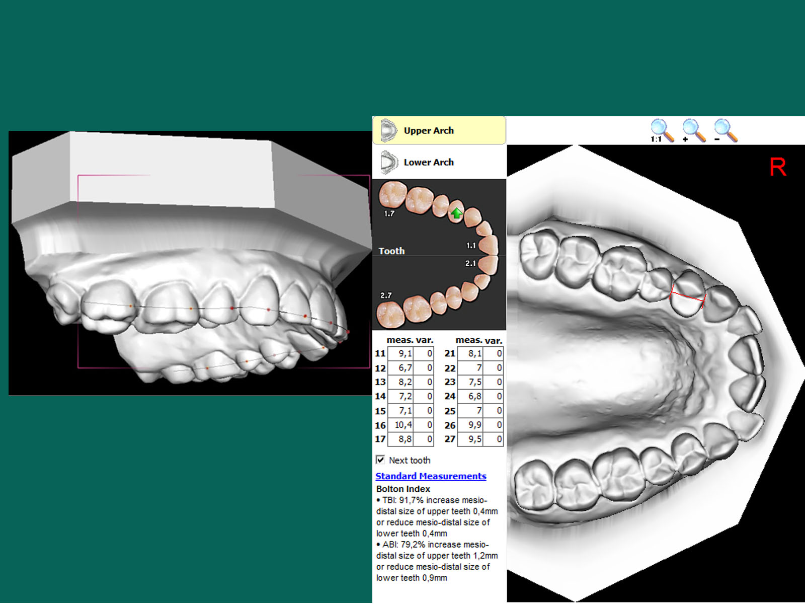 T3d Occlusogram